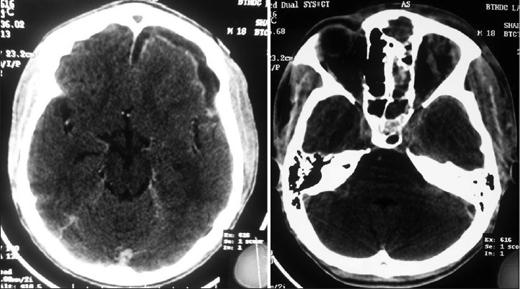Brain and bone window of cranial tomographic scan of a patient with ethmoidal sinusitis and subdural empyema